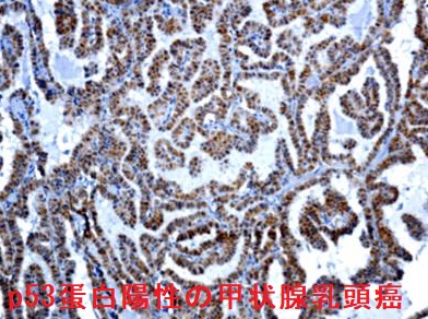 p53蛋白陽性甲状腺乳頭癌